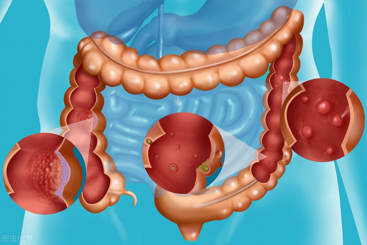 五种常见的癌前病变有哪些,癌前疾病与癌前病变的区别