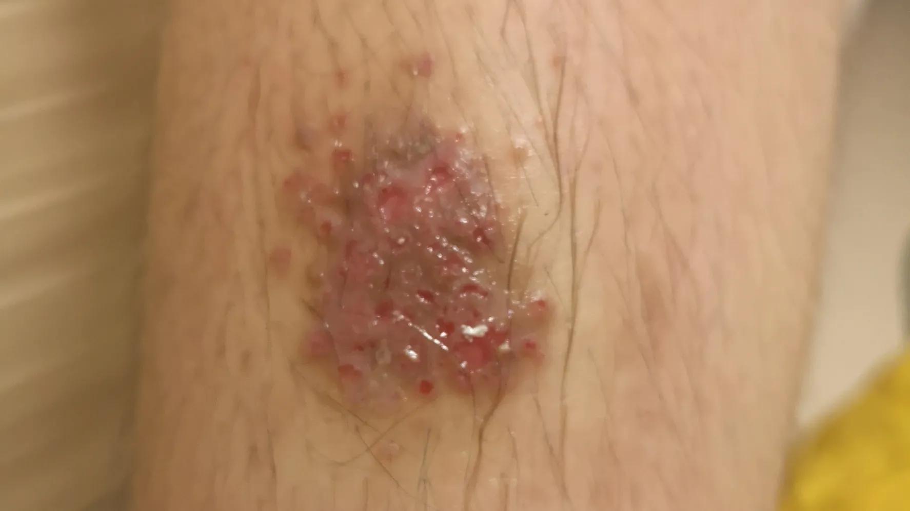 被蚊子咬了过敏反应严重,儿童蚊子咬后肿胀特别严重