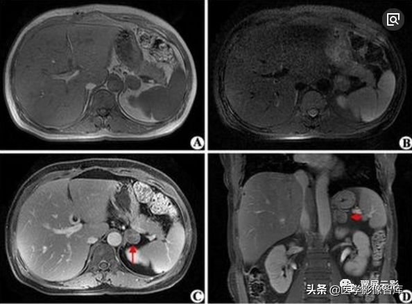 18种泌尿生殖系统常见疾病MR诊断总结