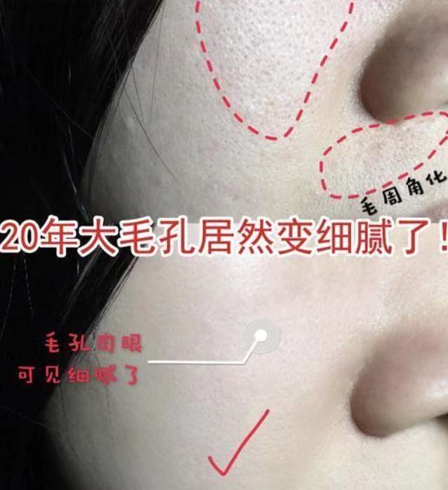 19岁姑娘打溶脂针,女子打美容针脸肿