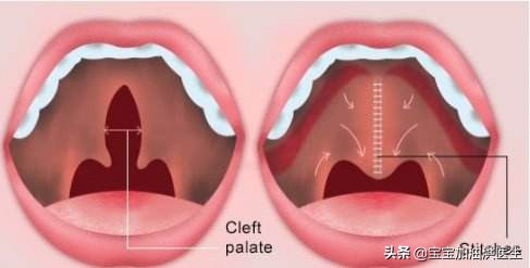 胚胎查出唇腭裂有什么后果,唇腭裂胎儿生下来怎么办