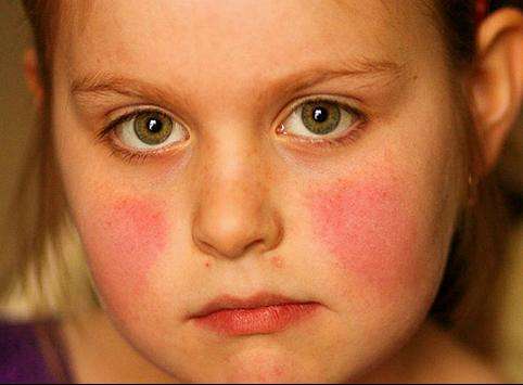 儿童脸上出现红疹怎么回事,孩子脸上有红疹是怎么回事