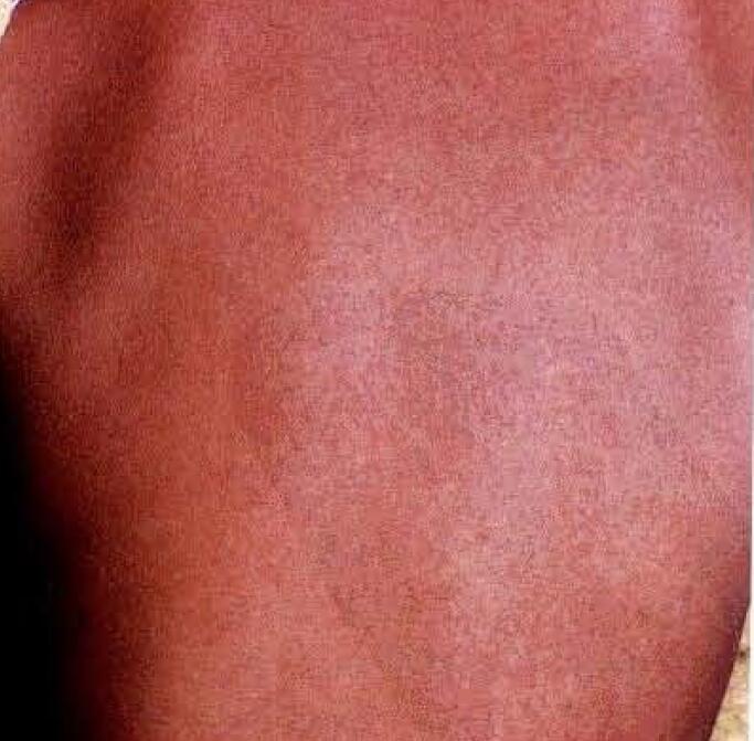 孩子喉咙痛低烧然后身上起疹子,儿童持续低热出疹喉咙痛