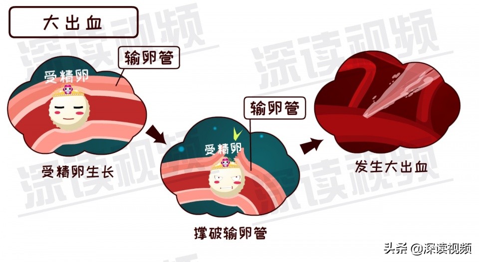 安以轩开刀保命实因宫外孕?受精卵去哪了?竟让孕妈流产大出血?