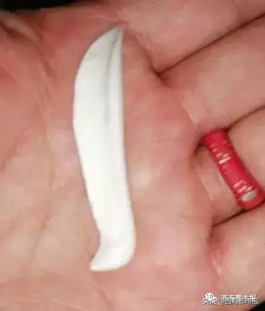 隆鼻后鼻尖一直化脓不好怎么办,女子花一万二做隆鼻手术却长脓包