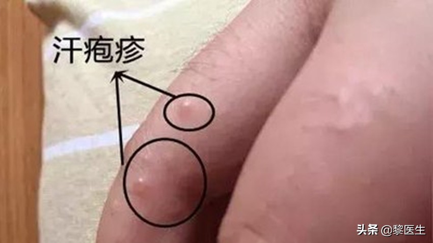 得了汗疱疹后感冒了,得了汗疱疹能健身吗