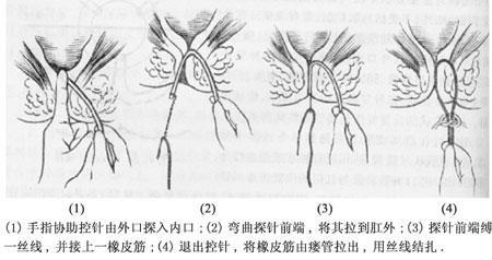 肛门瘙痒潮湿有分泌物用什么药,肛门潮湿有大便分泌物用什么药