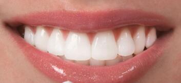 洗牙对牙齿有伤害吗能美白牙齿吗,洗牙美白的最快方法