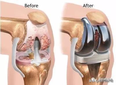 膝关节置换术后康复病历模板,做了膝关节置换术后康复视频