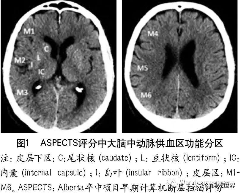 急性缺血性卒中诊治指南2023,缺血性卒中介入指南