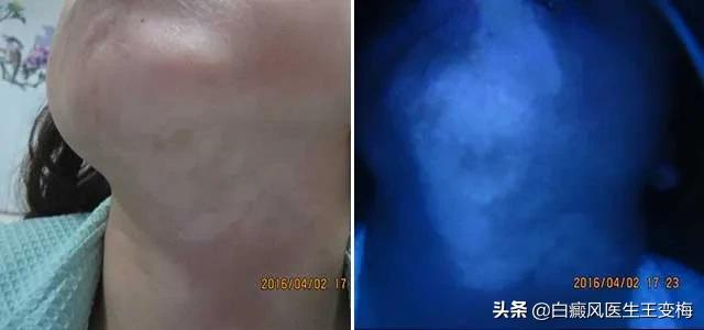 白癜风真的一旦得了就治不好吗,白癜风真的治不好了吗