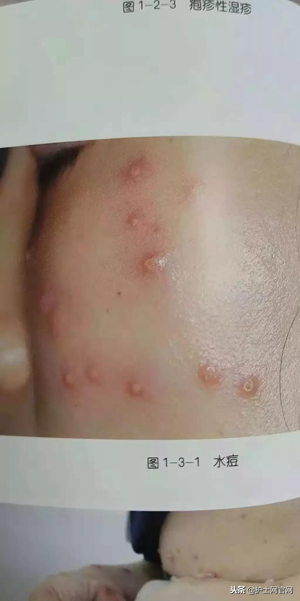 水痘病人的病房如何消毒,水痘患者应隔离至什么阶段