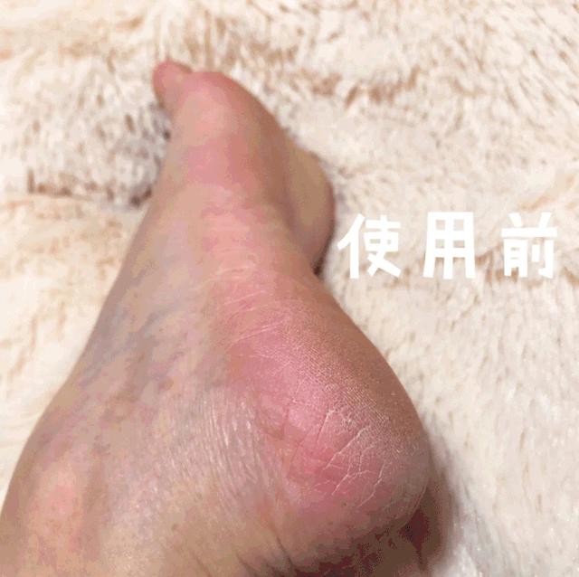 爽炸了!干丑裂的脚皮,一张完整撕掉,敢跟婴儿比姣嫩!