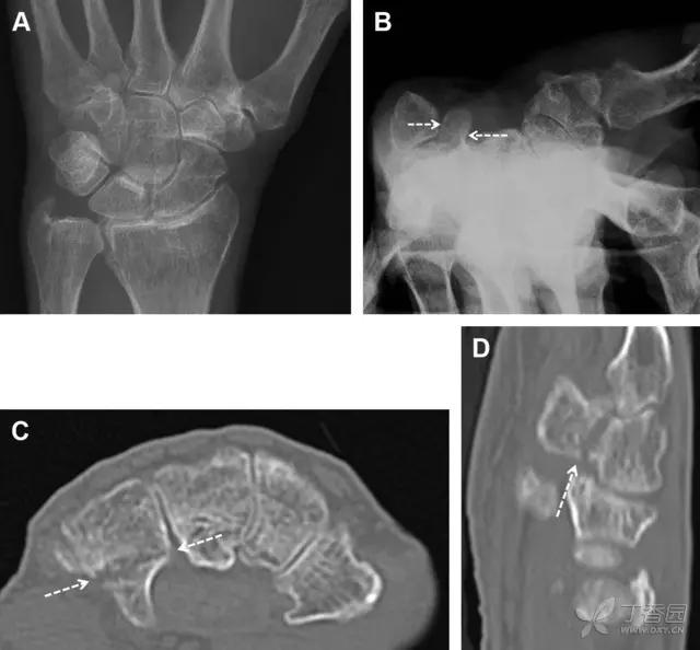 放射科夜班病例大全,放射科容易漏诊的骨折