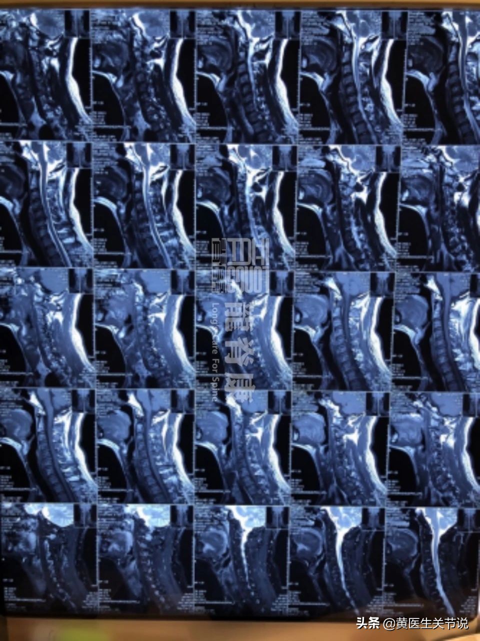 颈椎间盘突出什么情况需要手术,颈椎间盘突出硬膜囊受压手术费用