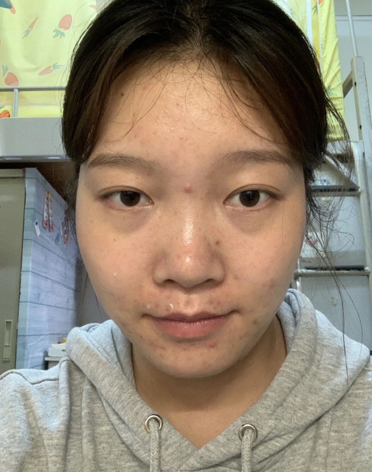 为什么你30岁还长痘？这几个恶习尽快改掉，否则皮肤状态很显老