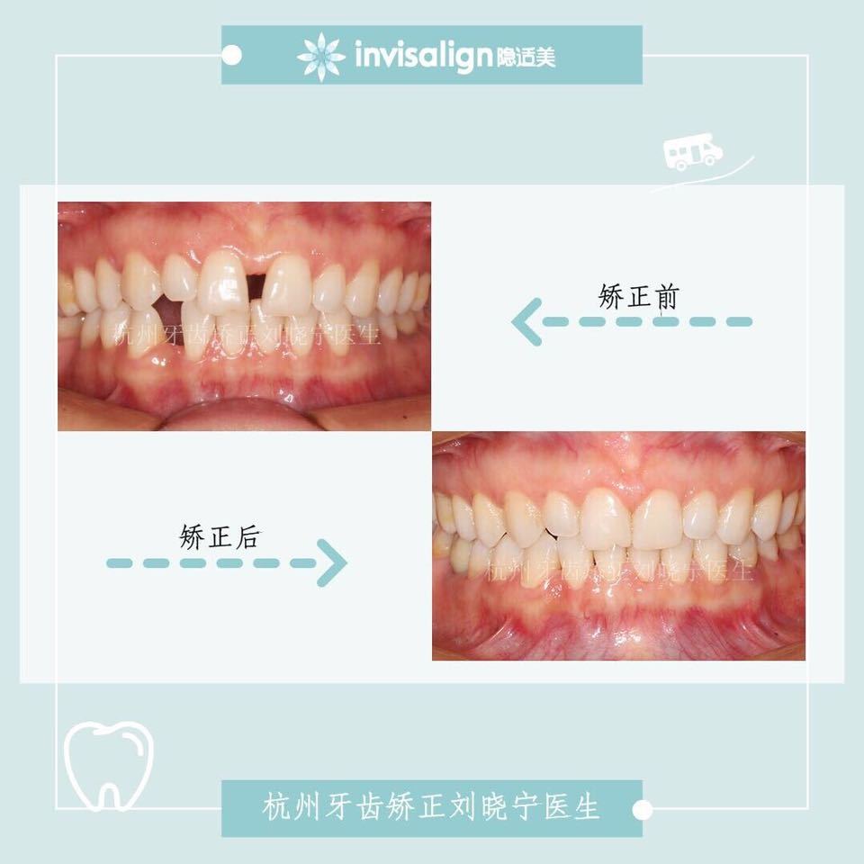 杭州牙齿深覆合矫正,杭州牙齿矫正有什么方法