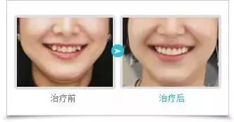 宠物虎需要拔牙吗,老虎牙齿拔掉可以饲养吗