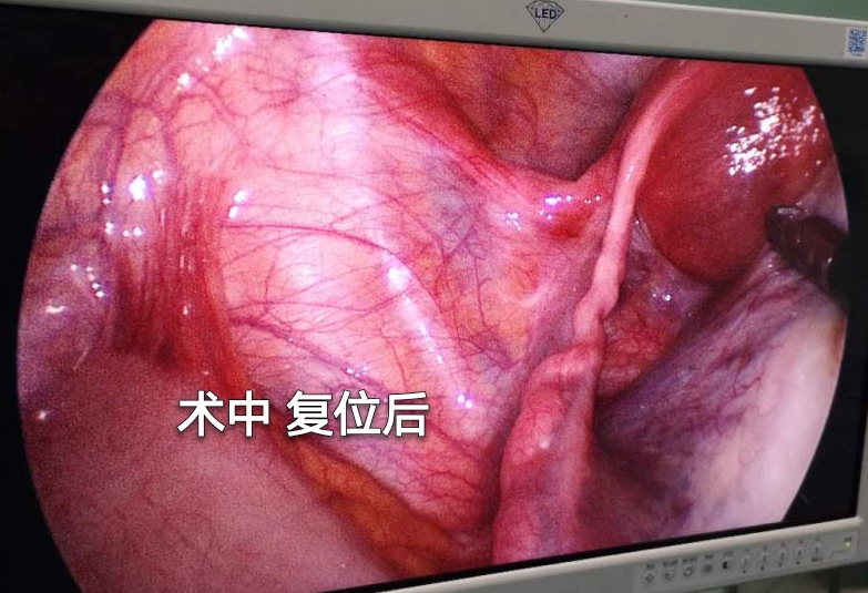 怀孕卵巢囊肿蒂扭转孩子能保住吗,怀孕卵巢囊肿扭转手术怎么做