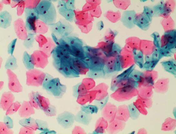 宫颈癌超全知识一次解决你的疑问,宫颈癌常见问题及解决