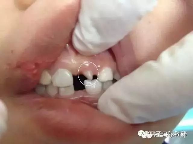 孩子多余的牙齿什么年龄适合拔掉,小孩子的牙齿需要填补吗