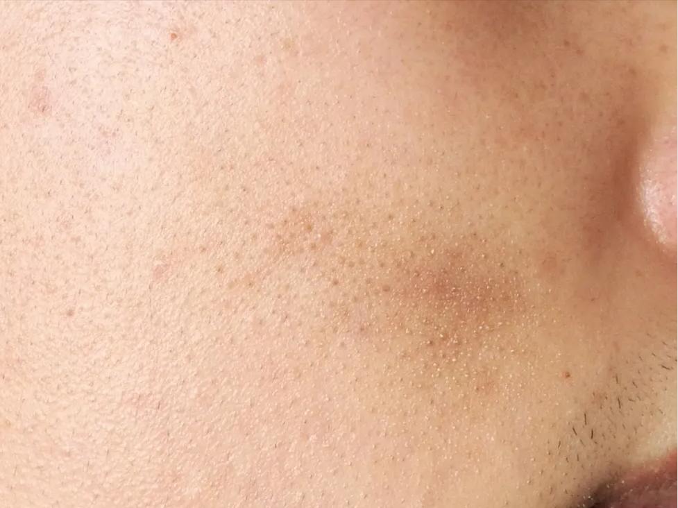 防晒隔离骨质疏松,防晒骨质疏松