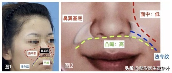 法令纹打玻尿酸还是做线雕效果好,线雕和玻尿酸祛除法令纹哪个好