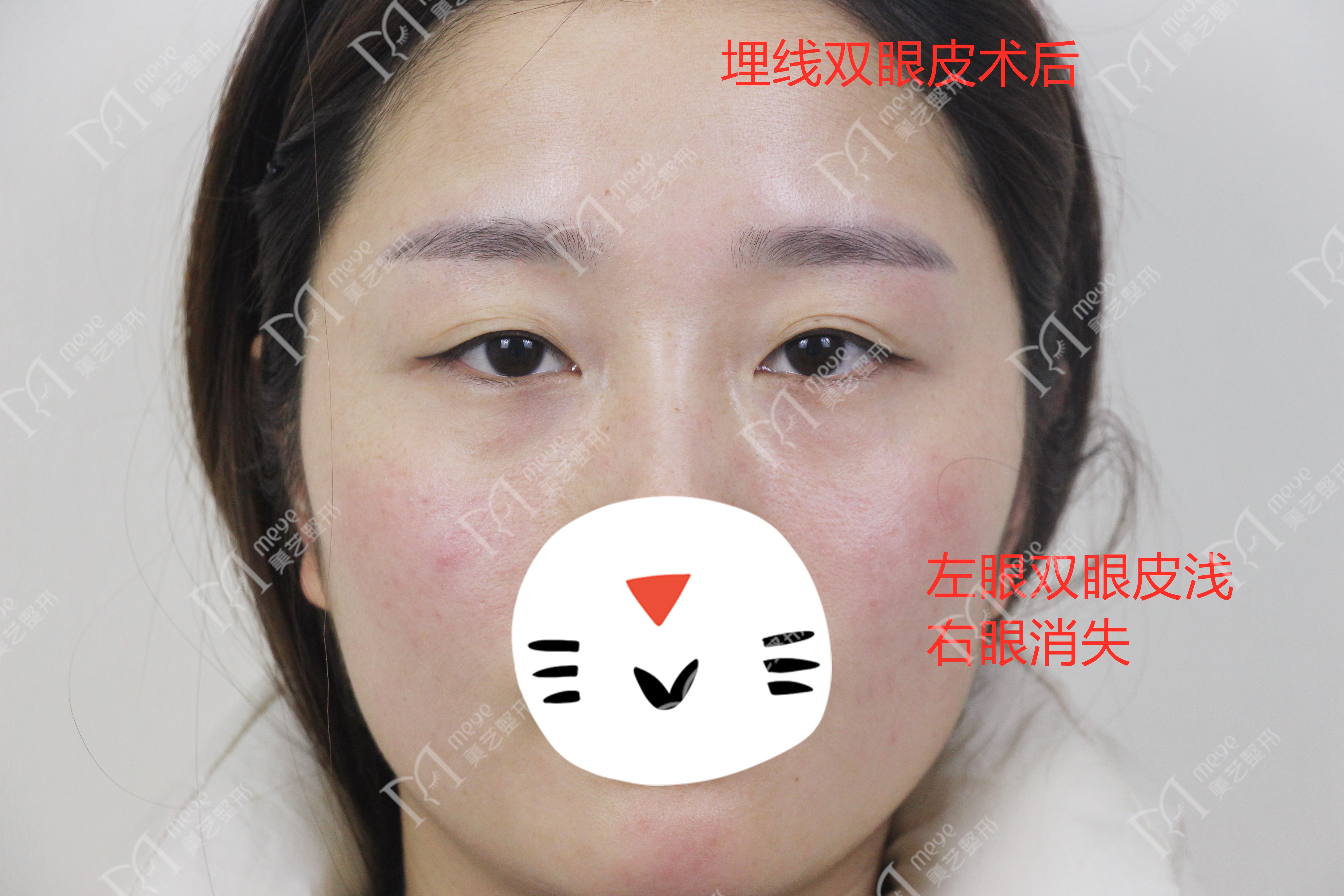 双眼皮失败了怎么修复好,双眼皮修复失败怎么解决