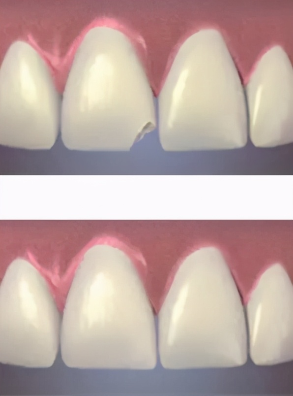 牙齿受外力横向断裂怎么办,牙齿意外脱落如何处理