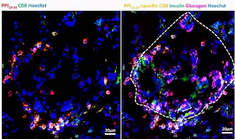 糖尿病干细胞研究进展,糖尿病医学研究进展
