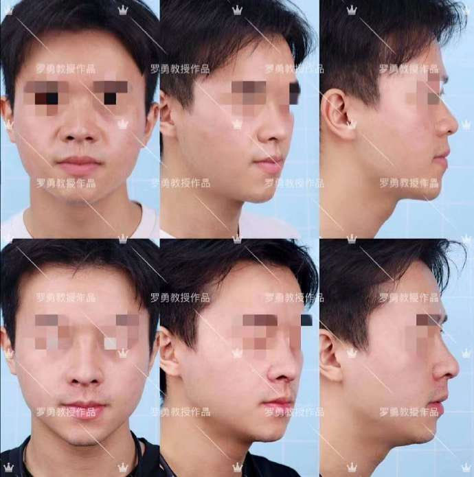 哪四种鼻子最不好看,宽鼻子好看还是窄鼻子好看