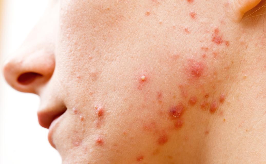 为什么身上会长“肉疙瘩”？是脂肪瘤吗？医生教你如何判断