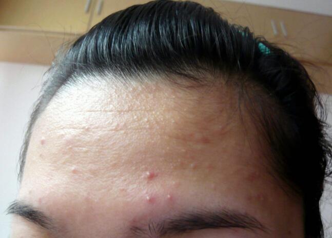 十七八岁脸上就长痘痘怎么祛痘,脸上反复长痘痘吃什么中药能祛痘