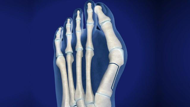 拇外翻大脚趾疼如何在家就能治,大脚拇指痛要警惕