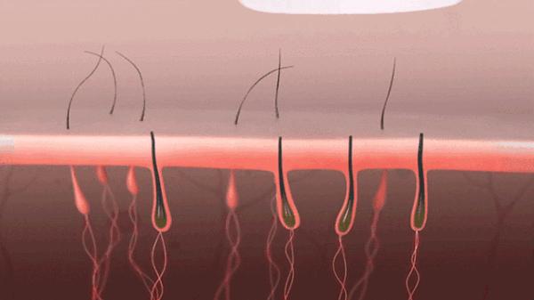 脱毛方法排行榜第一名,目前最好的脱毛技术