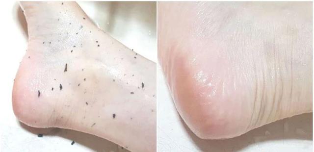 洗澡时搓出来的泥是怎么回事,为什么洗澡搓泥是白泥