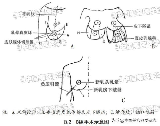 单侧乳房缩小成形术,乳房改良切除术