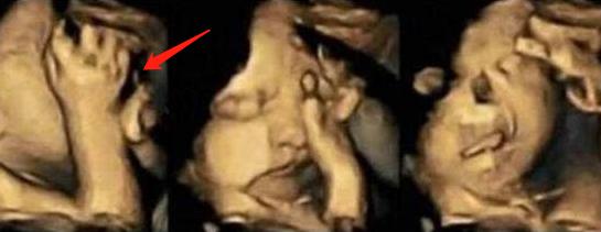 澶╂墠鑳庡効瀹岀粨,澶╂墠鑳庡効