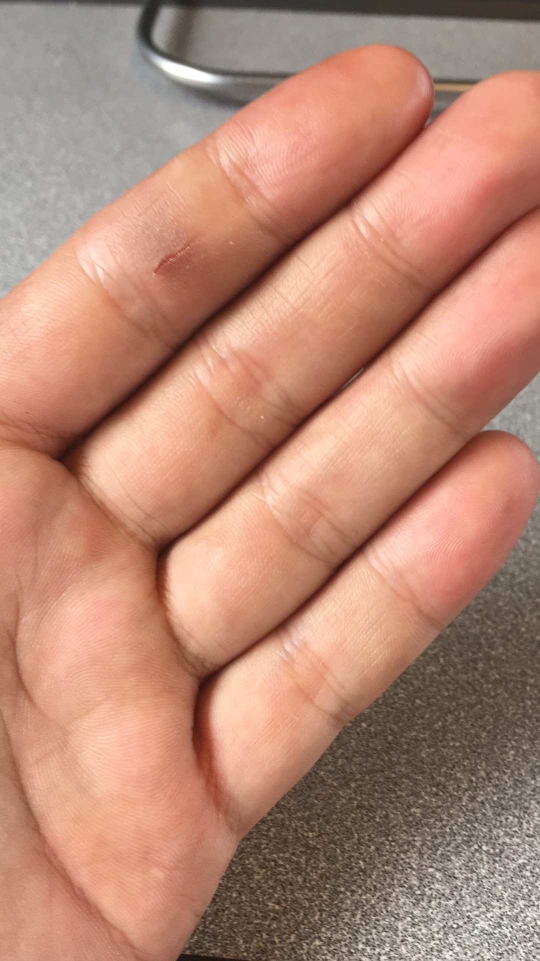 望大V能够分享一下|真实经历分享#钓鱼人#职业病之香虎手治疗方案