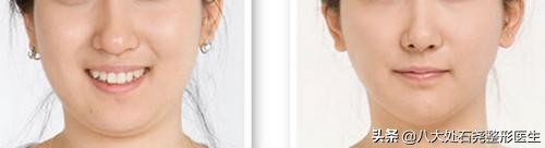 下巴脂肪堆积的解决方法,下巴脂肪过多怎么办