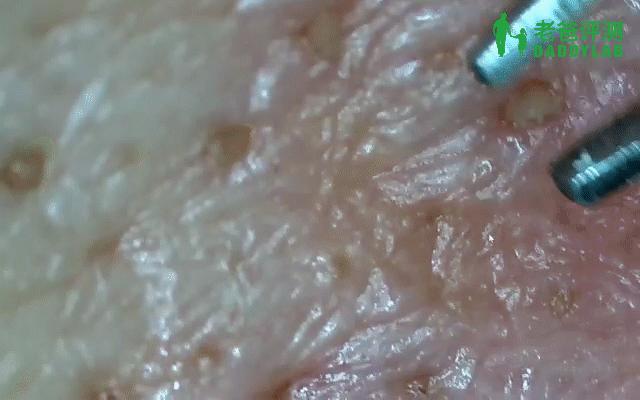 正确科学的去黑头方法一次说清楚,正确的去黑头的方法在这里