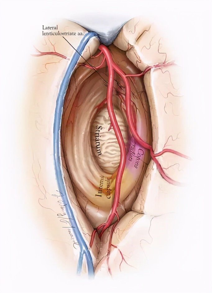 岛叶胶质瘤手术是开颅还是微创,岛叶良性胶质瘤复发率
