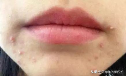 嘴巴周围老是反复长痘已经半年了,47岁嘴周围反复长痘什么原因