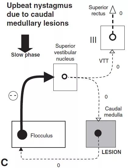 上跳性眼震能自愈吗,位置性眼震及眩晕