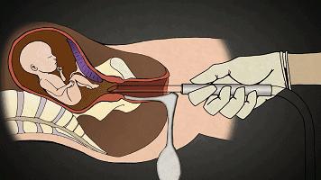 人流最多次案例,20岁女孩人流七次后续