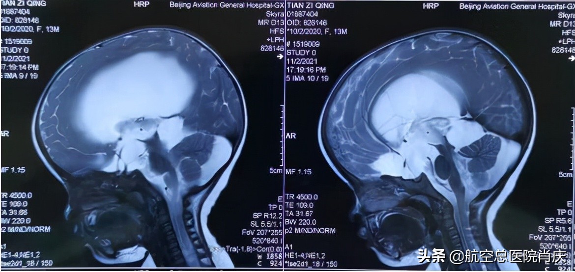 鞍上池蛛网膜囊肿手术费用,鞍上池蛛网膜囊肿影响智力吗