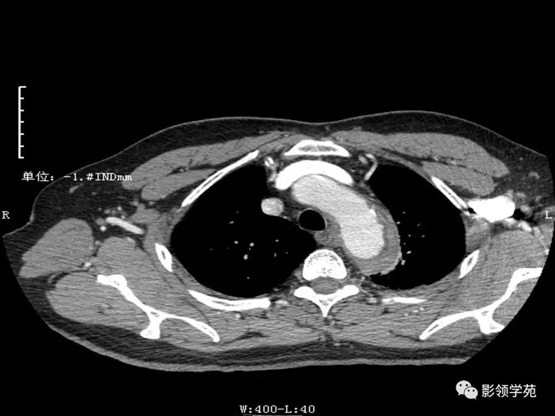 主动脉壁间血肿护理查房,主动脉夹层和壁间血肿图片