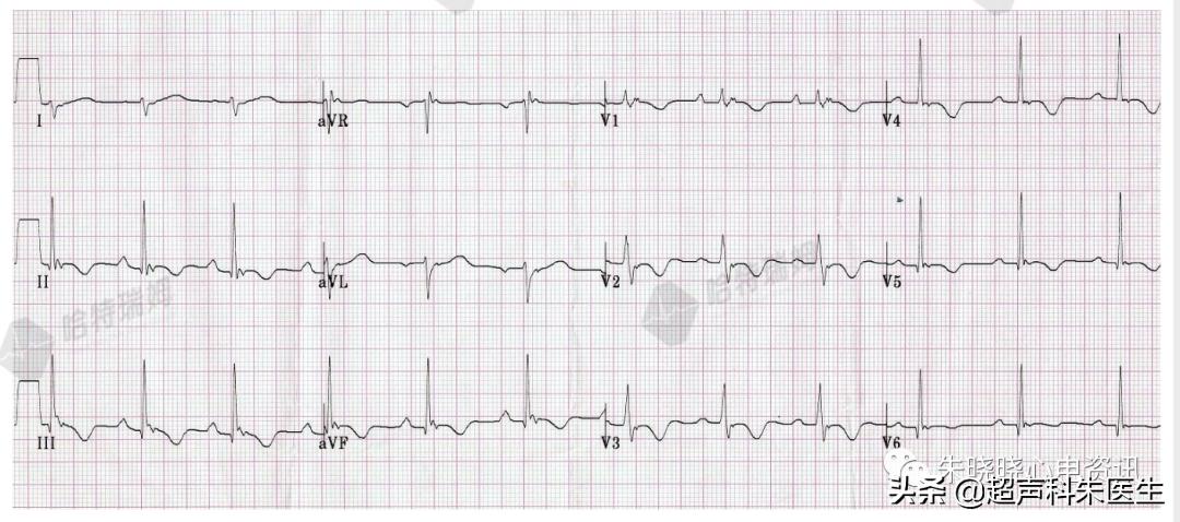t波倒置诊断,t波倒置如何区分严重程度