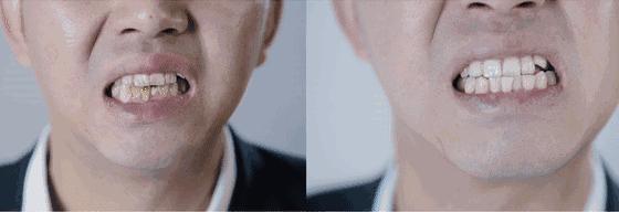 刷牙黄牙变成白牙怎么办,怎么刷牙才会让黄牙变成白牙