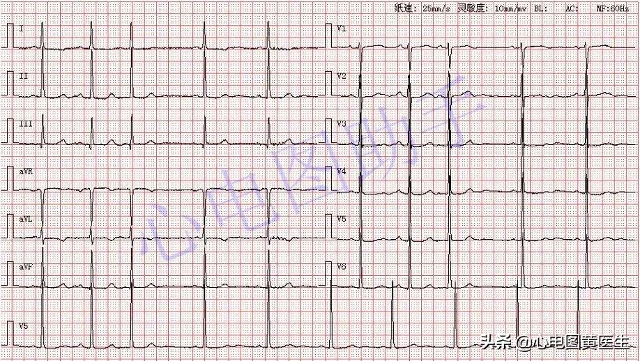 窦房结内游走性心律是什么意思,窦房结内游走性心律不齐